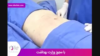 لیپوماتیک | فیلم لیپوماتیک | کلینیک پوست و مو نیل | شماره 24