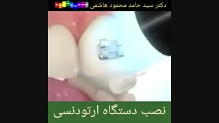 نصب براکت ارتودنسی