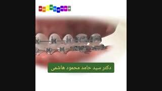 کش ارتودنسی برای هدایت دندان