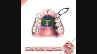 دستگاه پندولوم ارتودنسی | دکتر لادن طیبی