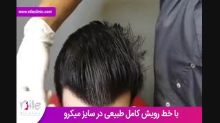 کاشت مو | فیلم کاشت مو | کلینیک پوست و مو نیل | شماره 26