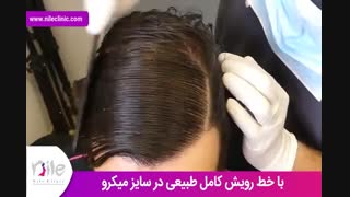 کاشت مو | فیلم کاشت مو | کلینیک پوست و مو نیل | شماره 27