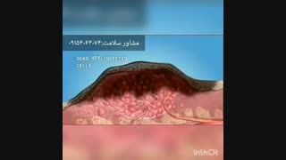لیزر و کرایو راه درمان زگیل تناسلی نیست