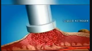 درمان زگیل تناسلی در زنان و مردان با لیزر توسط دکتر بیژن عابدیان