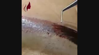 کاشت ابرو بدون درد وخونریزی