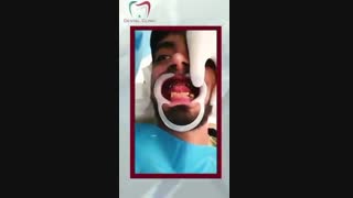 جراحی ایمپلنت دندان