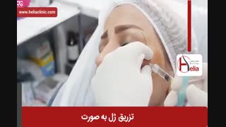 تزریق ژل | فیلم تزریق ژل | کلینیک پوست و مو هلیا | شماره 31