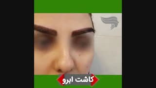 نحوه کاشت ابرو