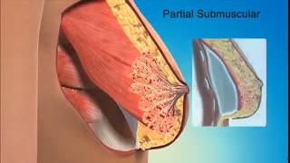 هر آنچه که باید قبل از عمل جراحی پروتز سینه بدانید ! - مجله پزشکی بیچشک