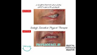 فلج بل چگونه است، فیزیوتراپیست صادق زراعتکار