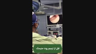 پارگی روت یا ریشه منیسک مدیال که تحت بازسازی و ترمیم