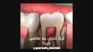 علائم ترک دندان