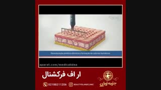 مراحل انجام آر اف فرکشنال روی پوست در قالب انیمیشن