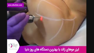 لیزر موهای زائد | فیلم لیزر موهای زائد | کلینیک پوست و مو نیل | شماره 24
