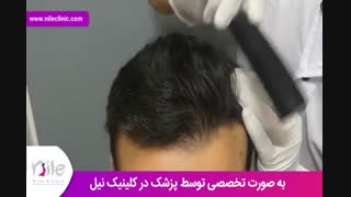کاشت مو | فیلم کاشت مو | کلینیک پوست و مو نیل | شماره 29