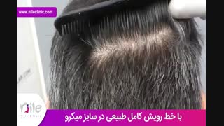 کاشت مو | فیلم کاشت مو | کلینیک پوست و مو نیل | شماره 30