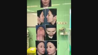 رینوپلاستی و رفع مشکلات تنفسی