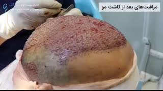 کاشت موی سر