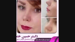 نمونه جراحی بینی دکتر حسن ختمی