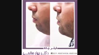 فیلر چانه ترمیم ونیر
