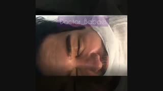 عمل کوتاه کردن پیشانی عصب‌کشی