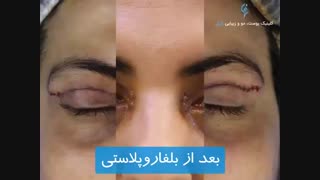 بلفاروپلاستی