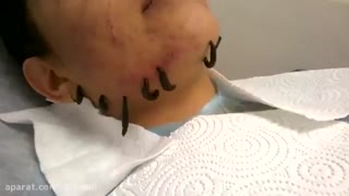 درمان جوش و آکنه صورت با زالو درمانی- کلینیک زالو درمانی پاسداران (دروس)