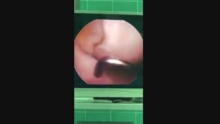 عوارض عدم درمان زانوی پرانتزی
