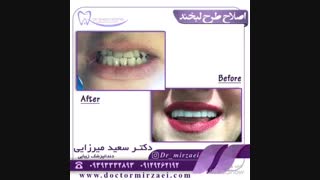 اصللاح طرح لبخند