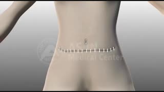 بازسازی سینه بعد از سرطان