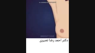 از کجا بفهمیم سرطان سینه داریم ؟