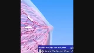 سرطان سینه چگونه به وجود می آید ؟