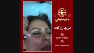 نمونه کار تزریق ژل جزیره زیبائی