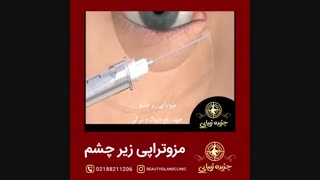 روش مزوتراپی زیر چشم