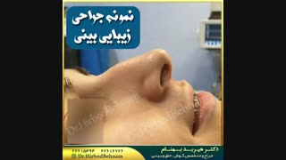 فیلم جراحی زیبابی بینی