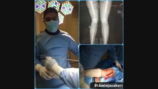 عمل جراحی استئوتومی زانوی پرانتزی