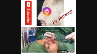 مراحل جراحی بینی