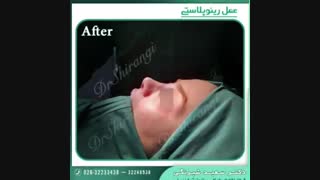 نمونه کار جراحی بینی دکتر سعید شیرنگی