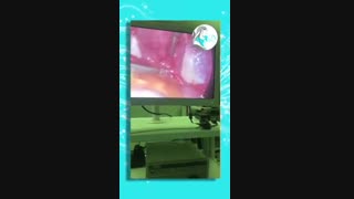 پارگی رحم  توسط آی یو دی