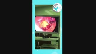 عمل لاپاراسکوپی میومکتومی