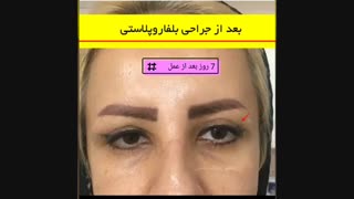 جراحی بلفاروپلاستی
