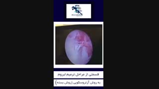 پارگی شدید و مزمن لبروم شانه