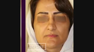 ماندگاری تزریق چربی صورت تزریق بوتاکس