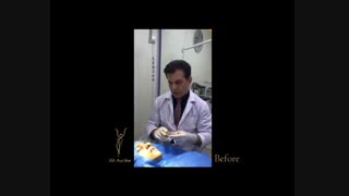 اصلاح قوز بینی