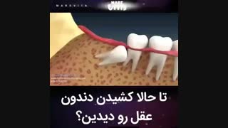 جراحی دندان عقل-دکترمجیدقیاسی دندانپزشک زیبایی مشهد
