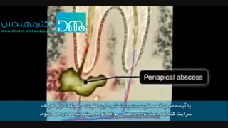 همه چیز در مورد آبسه و عفونت دندان