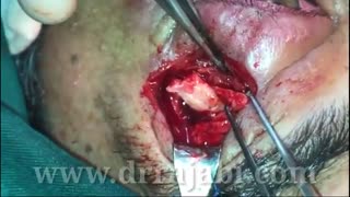 بازسازی شکستگی کاسه چشم با جا به جایی استخوان