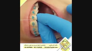 استفاده از نخ دندان سوپر فلاس | دکتر طیبی