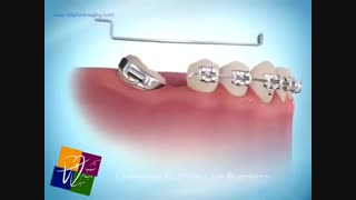 صاف کردن دندان‌ها