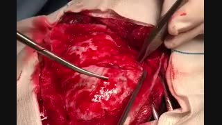 آسیب هاى تروماتیک مغزى